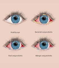 what is pink eye how to prevent