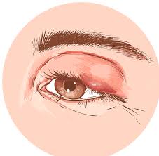 eyelid problems eyecare 20 20