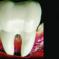 impacted wisdom teeth types causes