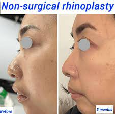 non surgical rhinoplasty recovery time