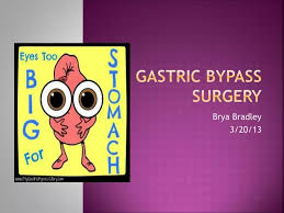 ppt gastric byp surgery powerpoint
