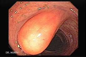 lipomas of the colon the