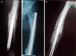 expandable intramedullary nailing and