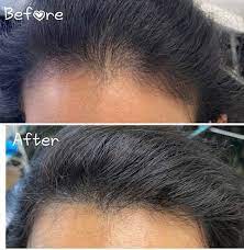 prp for hair loss toronto can
