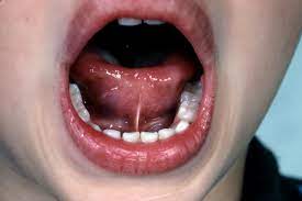 consequences of untreated tongue tie