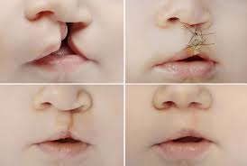 cleft lip and palate treatment houston