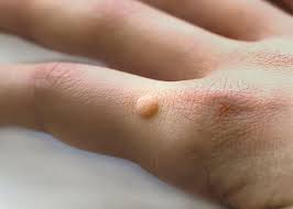 common warts verruca vulgaris