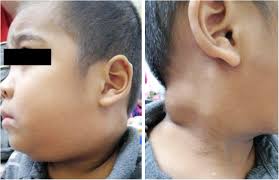 nodal histiocytic disorder in children