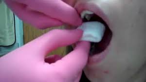 tooth extraction gauze