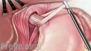 hernia hiatal laparoscopic surgery