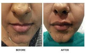 best lip augmentation surgery delhi