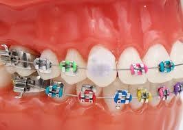 caring for braces i orthodontics
