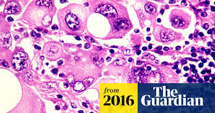 Navigating the choices for skin cancer treatment starts with understanding your options. Drug Combination For Treating Skin Cancer Approved For Nhs Use Skin Cancer The Guardian