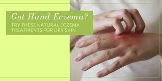 natural eczema treatments for dry skin