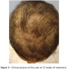 The chronic use of strong topical steroids (such as clobetasol) will cause hair loss. Scielo Brasil Alopecia Areata Incognita Alopecia Areata Incognita