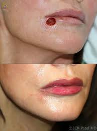 lip lines patel plastic surgery bck