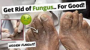 foot fungus naturally