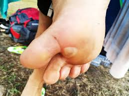 do you have a blister under your foot