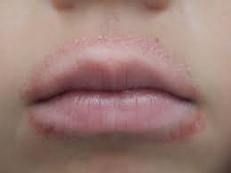 dry skin above upper lip causes and