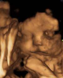 3d ultrasound cleft lip babycenter