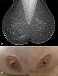 A breast biopsy shows loose fibroconnective tissue with a sarcomatous stroma, abundant mitoses. Multimodality Approach To The Nipple Areolar Complex A Pictorial Review And Diagnostic Algorithm Insights Into Imaging Full Text