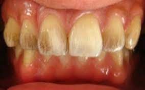 If you eat acidic foods after drinking coffee, they can damage your teeth faster. How To Distinguish Between A Coffee Stain On Your Teeth And A Cavity Quora