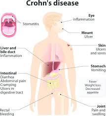 crohn s disease symptoms causes