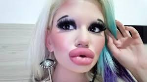 woman triples size of her lips with 15