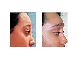 brow bone and forehead augmentation