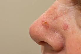 actinic keratosis for columbia md