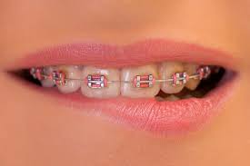 Although i cant eat well bcos my teeth feels sensitive to pressure. What To Expect When Getting Braces On Top Teeth Only Fine Orthodontics Blogfine Orthodontics Blog