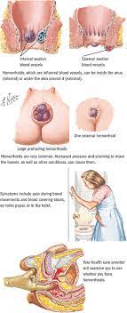 Internal hemorrhoids, also known as inner hemorrhoids or internal piles, are swollen vascular structures that can cause some unpleasant problems, even if you don't feel them. Hemorrhoids Digestive Health And Disorders Spectrum Health