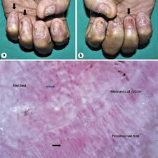 pterygium complicating nail psoriasis