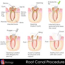 root c infected tooth stockton ca