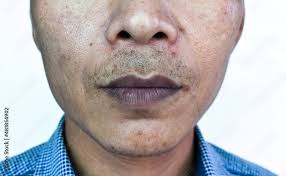 cyanotic lips or central cyanosis at