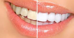 the top 3 diy teeth whitening methods