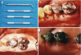 periodontal surgery springerlink