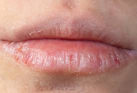 dehydrated dry lips chapped lips