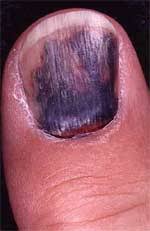 nail diseases disorders