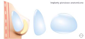 Implanty piersi – anatomiczne czy okrągłe?