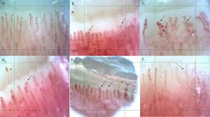 nailfold videocapillaroscopic changes