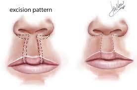 secondary cleft lip repair springerlink