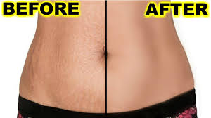 can body makeup cover stretch marks