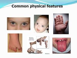 Down syndrome is caused by triplicate material of chromosome 21. Down Syndrome