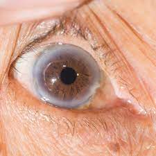 high cholesterol and the eyes signs