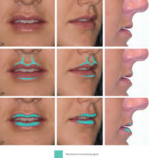 6 lip and peri cosmetic surgery