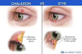 what is a chalazion p on eyelid