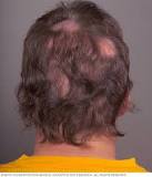 what-causes-hair-thinning