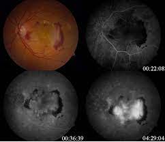 Age Related Macular Degeneration Eyewiki