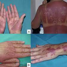 a chemotherapy induced acral erythema